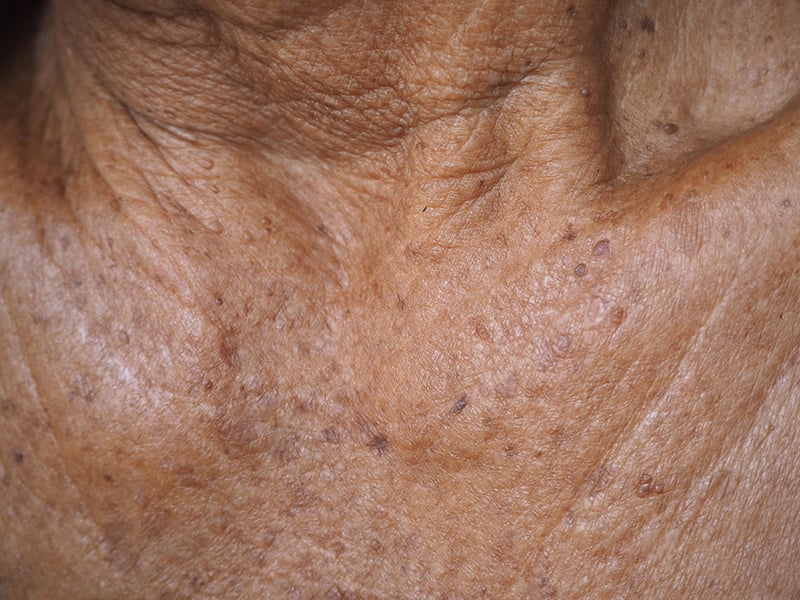 Actinic-Keratosis (2)