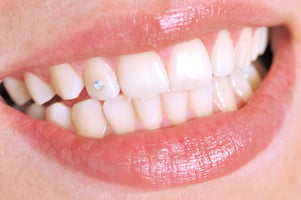 Diamond teeth in Dubai