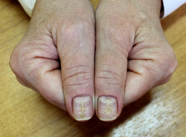 Median-Canaliform-Nail-Dystrophy