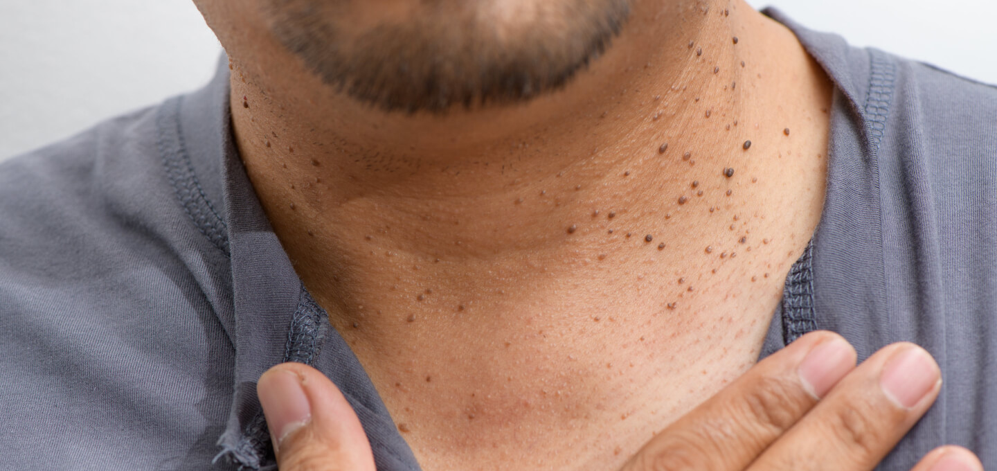 Seborrheic keratosis in Dubai 5