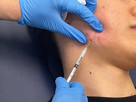 Keloid Scar Injection in Dubai