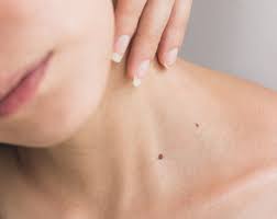 Dermoscopy Mole Evaluation in Dubai