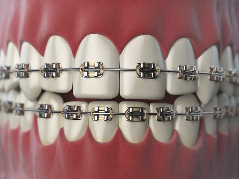 Dentofacial Orthodontic Treatment in Dubai