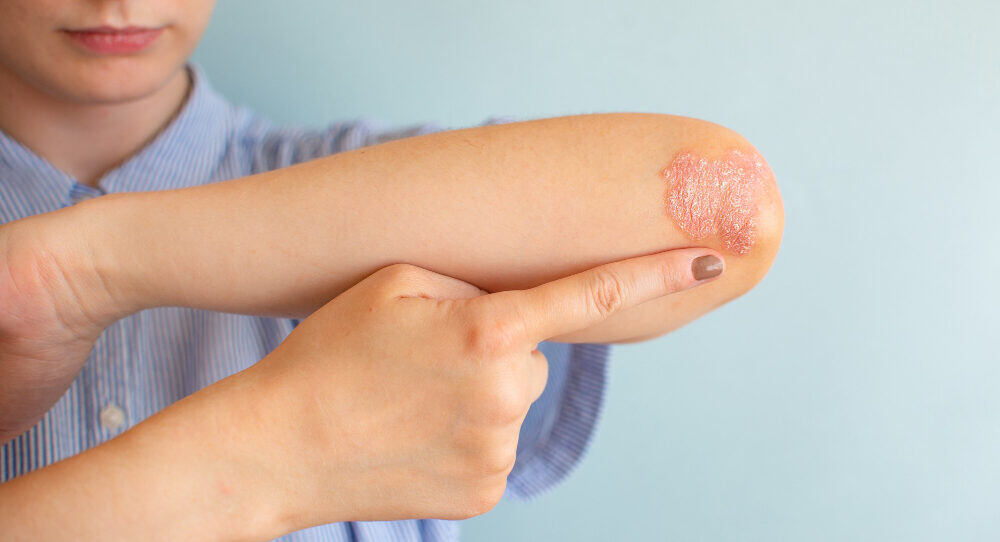 Skin Diseases in Dubai